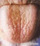 中医舌诊图谱100例,靠谱中医史上最全高清舌诊图谱