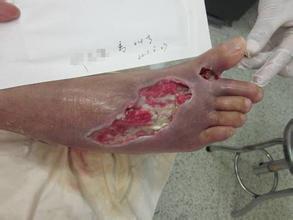 糖尿病一旦出现并发症怎么办,糖尿病最可怕的五种并发症的治疗