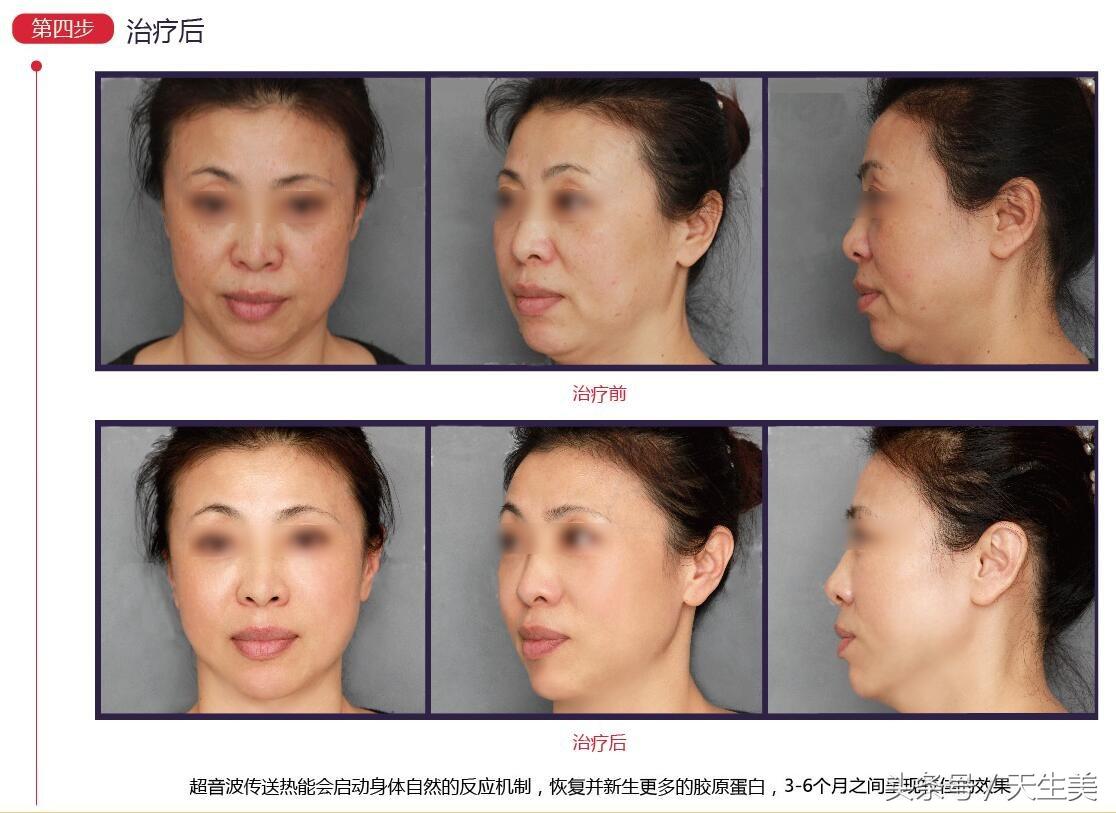 超声刀怎么样啊 (超声刀分享)