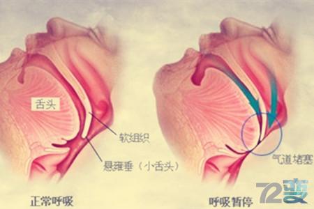 生理打鼾,鼾症有效的辅助器械