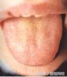 中医舌诊图谱100例,靠谱中医史上最全高清舌诊图谱