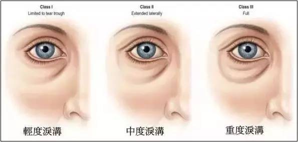 有泪沟怎么办最有效方法,有泪沟怎么办