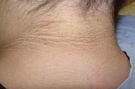 脸上长黄斑怎么检查,看脸上的斑如何知道什么病因