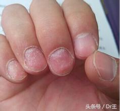 在美甲店做了美甲后手指一直起皮,在美甲店做的美甲掉漆了