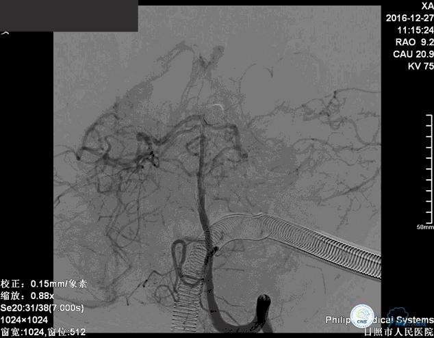 颈动脉瘤介入栓塞康复后可活多久,动脉瘤微创栓塞术全过程