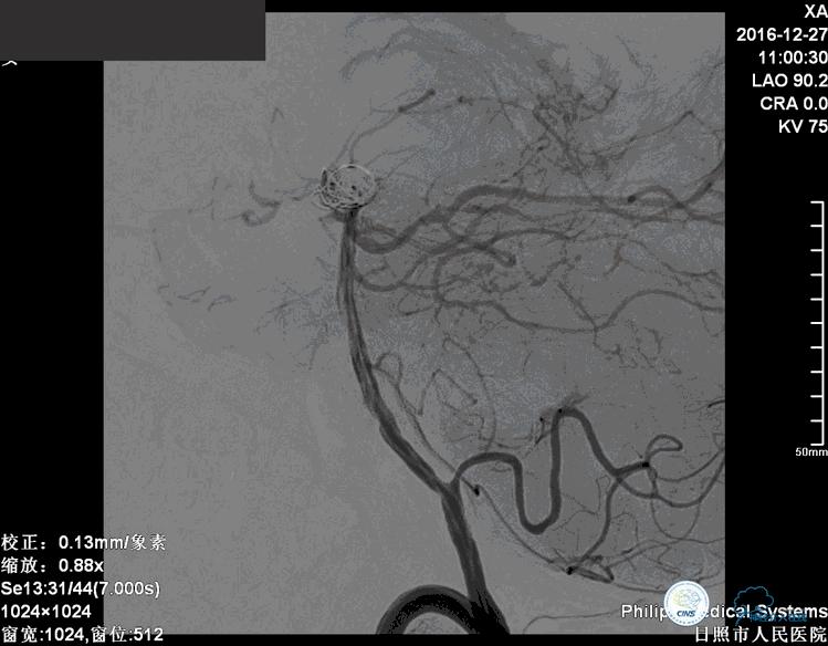 颈动脉瘤介入栓塞康复后可活多久,动脉瘤微创栓塞术全过程