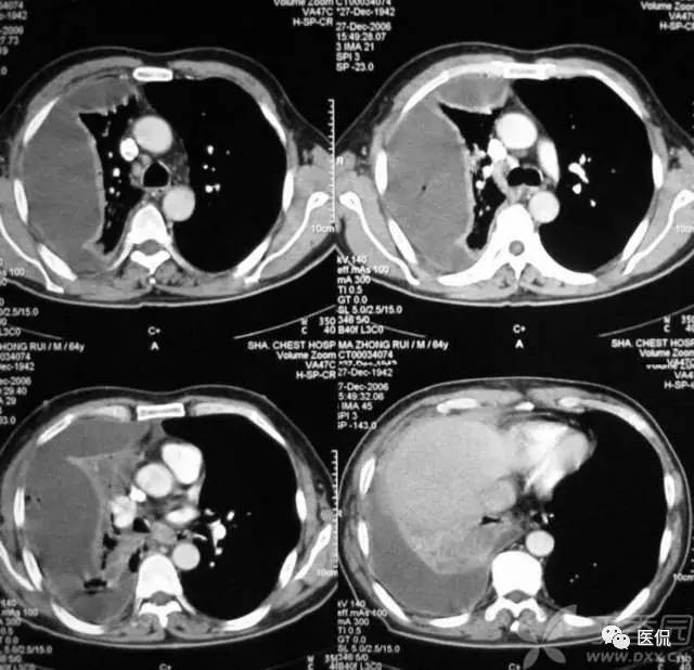 影像学呼吸系统理论知识,呼吸系统疾病影像学常见征象