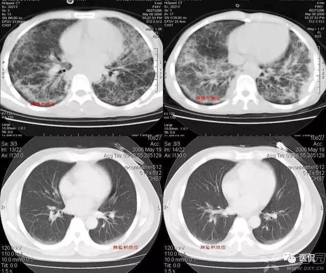 影像学呼吸系统理论知识,呼吸系统疾病影像学常见征象