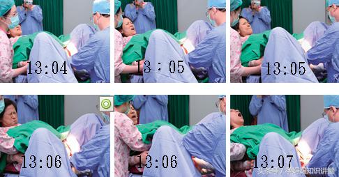 产妇自然分娩有几个产程,分娩第一天产妇注意什么