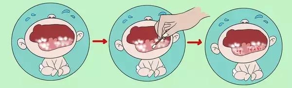 鹅鹅鹅鹅口疮，你需要知道这些