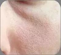 身体毛孔粗大并且里面是黑的,毛孔粗大变成了一个洞