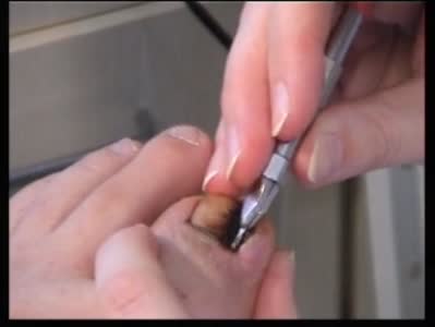 服用盐酸厄洛替尼片饮食禁忌 (吃厄洛替尼片有什么副作用)