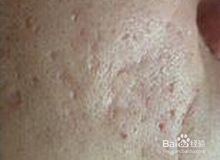 祛痘的小窍门教你如何快速消痘痘,长痘怎么办如何拯救痘痘肌肤