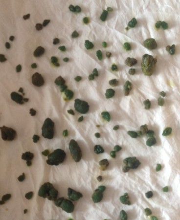 这就是肝脏结石！看完是不是觉得挺恐怖的？