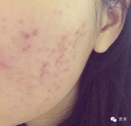 长痘痘好焦虑啊,长痘痘要用什么药治疗