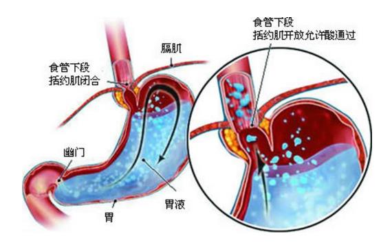 西苑医院消化科唐旭东教授:胃食管反流患者饮食需注意四个有