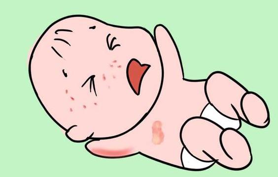 深度水解奶粉喝多久湿疹能缓解,宝宝湿疹喝氨基酸奶粉后没有缓解