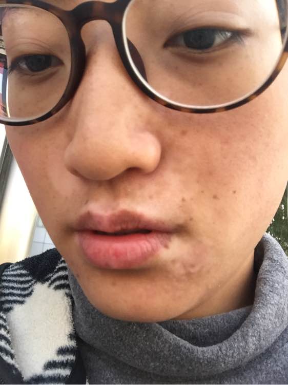 白斑光照,白斑光照后图片