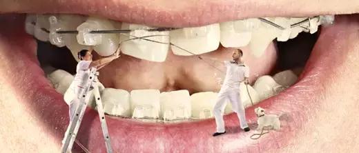 牙套上有钢丝怎么处理,钢丝牙套太丑怎么办