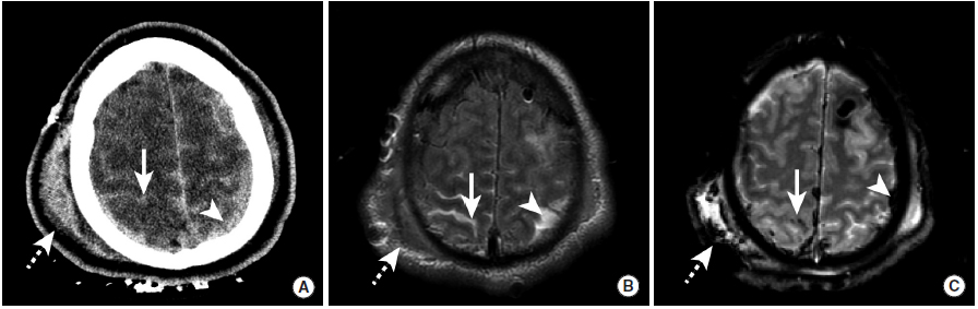 多图颅内出血影像学表现大全,头被撞后颅内出血有什么表现