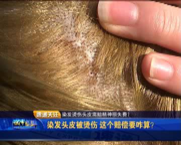 染发把头皮染破了要怎么赔偿,理发店烫伤头皮如何赔偿