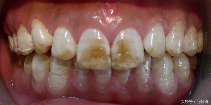 8岁孩子牙齿上有白斑怎么办,为什么牙齿会有白斑
