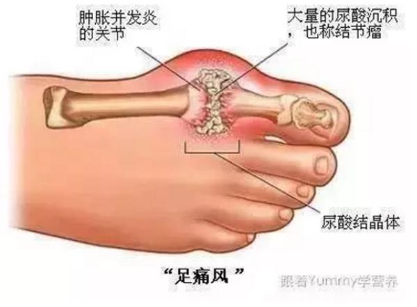 痛风与关节炎的认识,教你认识痛风