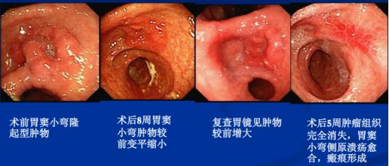 pdt光动力治疗肿瘤,肿瘤的mdt在肿瘤综合治疗中的地位