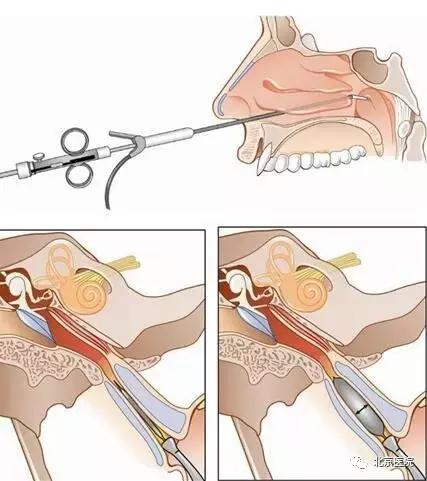 原来坐飞机难受是因为TA,听听北京医院专家怎么说?