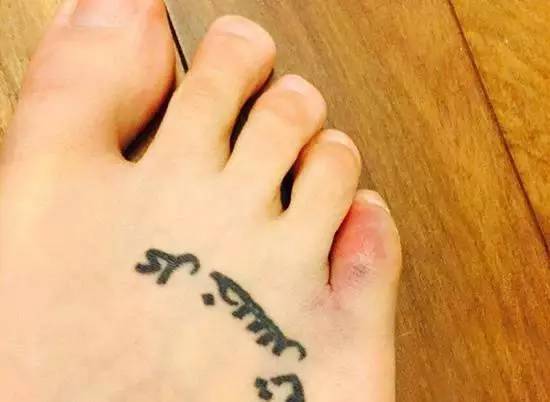 脚趾头又痒又痛又肿,脚趾头起小水泡又痒又脱皮