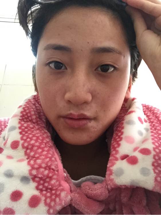 白斑光照,白斑光照后图片