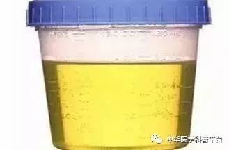 看尿液颜色判断身体有多少水,通过尿液颜色也能辨健康