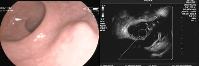 当EUS遇到“假瘤子”(二)——都是“隔壁老王”惹的祸(毗邻外压)