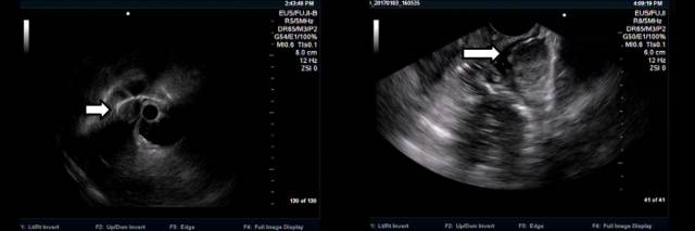 当EUS遇到“假瘤子”(二)——都是“隔壁老王”惹的祸(毗邻外压)