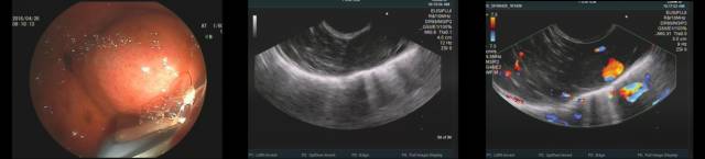 当EUS遇到“假瘤子”(二)——都是“隔壁老王”惹的祸(毗邻外压)