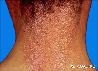 神经性皮炎牛皮癣湿疹会传染吗,头皮神经性皮炎和牛皮癣的区别