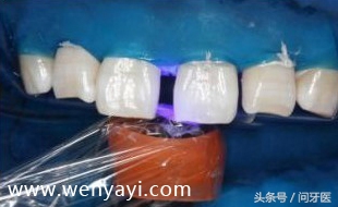 门牙有缝是什么说法,门牙有缝怎么办如何补救
