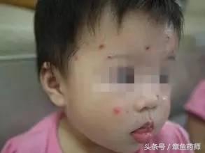 注意水痘高发期这些知识需知,小心传染病高发期