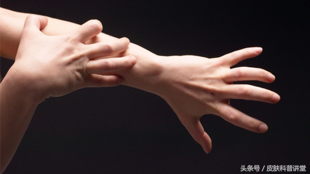 反复神经性皮炎是缺什么,神经性皮炎反反复复如何根除