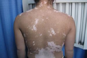 怎样治疗白癜风效果好呢,肢端型白癜风用308治疗有效吗