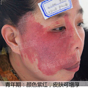 为什么红胎记会突出皮肤表面,光动力治红胎记失败