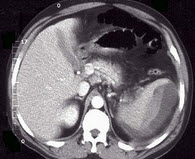 不作死就不会死，这个小哥终于把自己脾脏作掉了