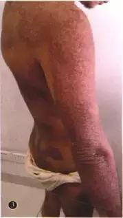 全身角化病,全身出现多处皮肤癣是什么引起的