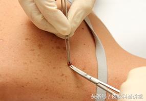 小孩传染性软疣冷冻后变成了水泡,儿童常见皮肤病疣