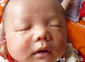 新生儿最易出现的10种皮肤问题,刚出生的小孩皮肤病怎么治