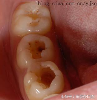 蛀牙会散发臭味吗,抠蛀牙洞臭