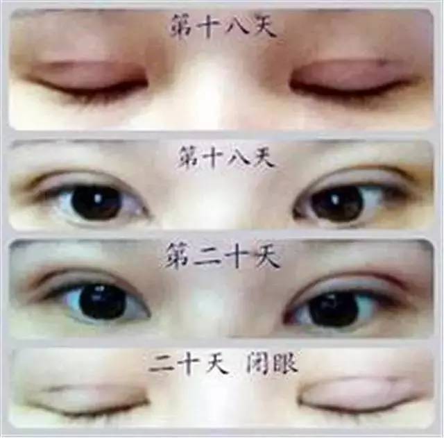 双眼皮怎么割没肉条感,双眼皮怎么显得更宽