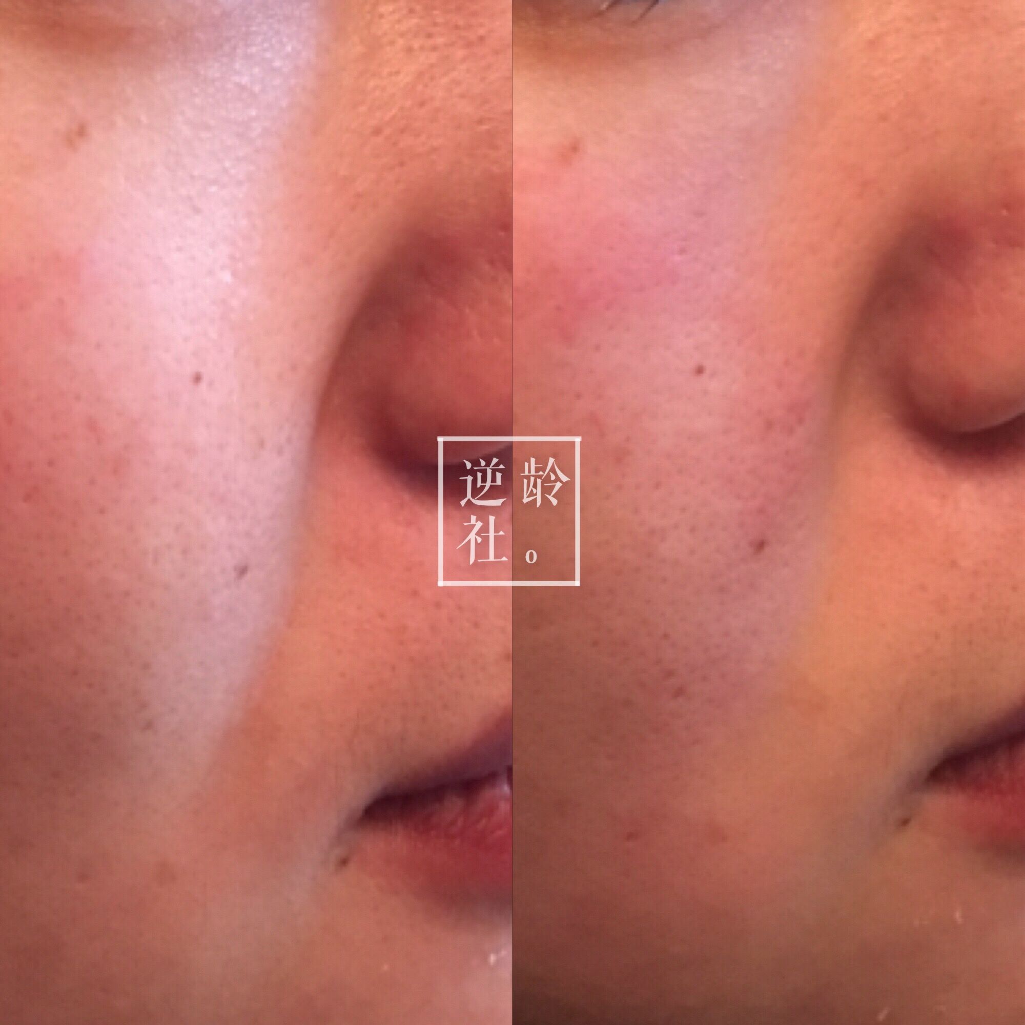 已经做了超声刀如何补救,逆龄精雕好还是超声刀好