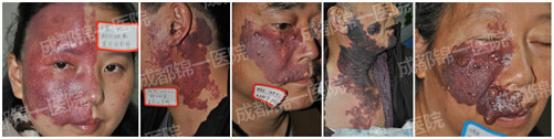 鲜红斑痣到底需不需要治疗？这个难题有答案了