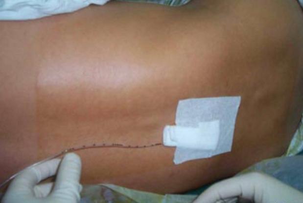 剖腹产三年了还痛又痒怎么回事,剖腹产快2年了偶尔还隐隐疼